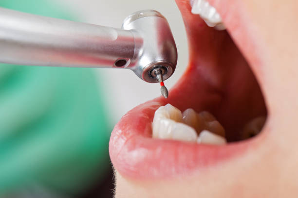 Best Emergency Dental Extractions in Bluewell, WV